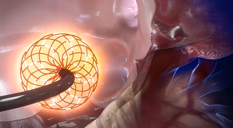 Az új katéter 3D számítógépes animációja, jelenleg klinikai vizsgálatok alatt áll
